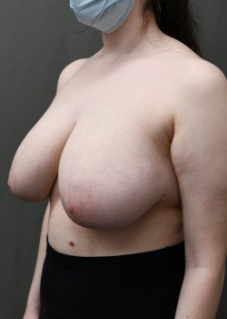 Breast Reduction