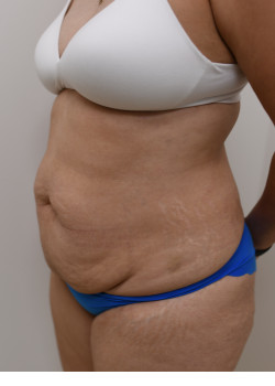 Tummy Tuck