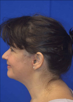 Facelift/Necklift/Browlift