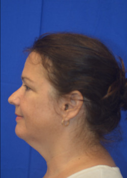 Facelift/Necklift/Browlift