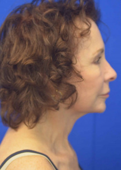 Facelift/Necklift