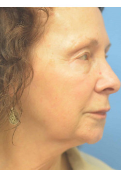 Facelift/Necklift