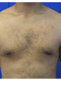 Gynecomastia