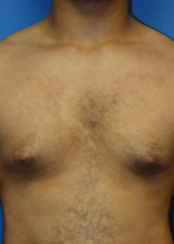 Gynecomastia