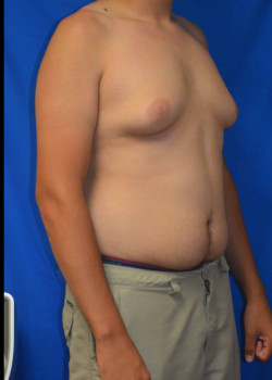 Gynecomastia