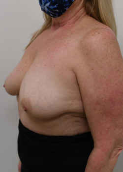 Breast Augmentation with Breast Lift