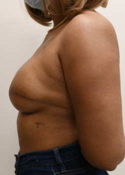 Breast Reconstruction