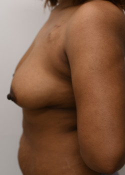 Breast Reconstruction