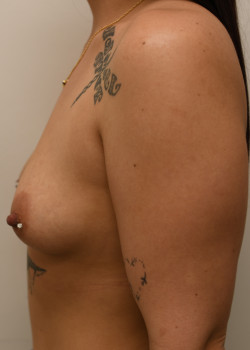 Breast Augmentation