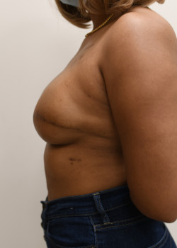 Breast Reconstruction