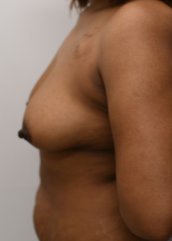Breast Reconstruction