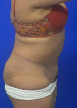 Abdominoplasty/Tummy Tuck