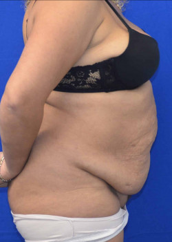 Abdominoplasty/Tummy Tuck