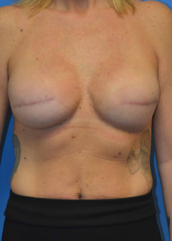 Breast Reconstruction–Tissue Expander/Implant