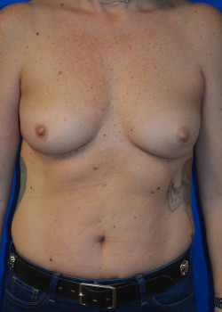 Breast Reconstruction–Tissue Expander/Implant