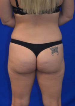 Buttock Augmentation