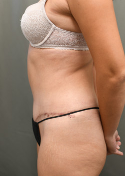 Abdominoplasty/Tummytuck