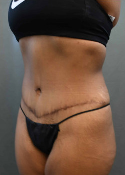 Abdominoplasty/Tummytuck