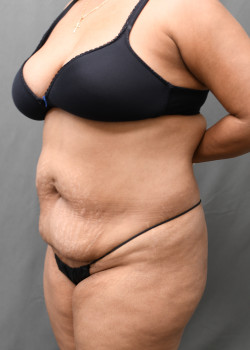 Abdominoplasty/Tummytuck