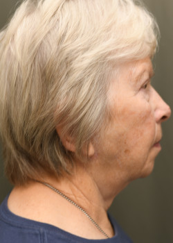 Neck Lift and Upper Blepharoplasty