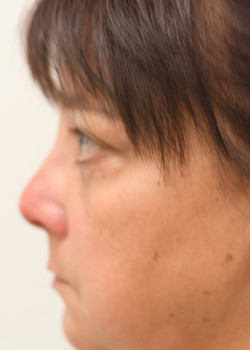 Lower lid Blepharoplasty