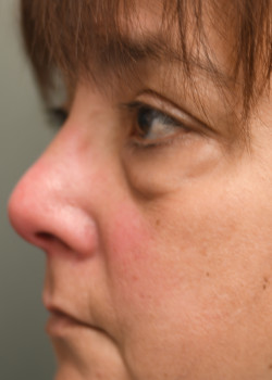 Lower lid Blepharoplasty