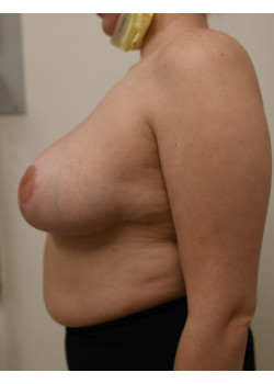 Breast Reduction